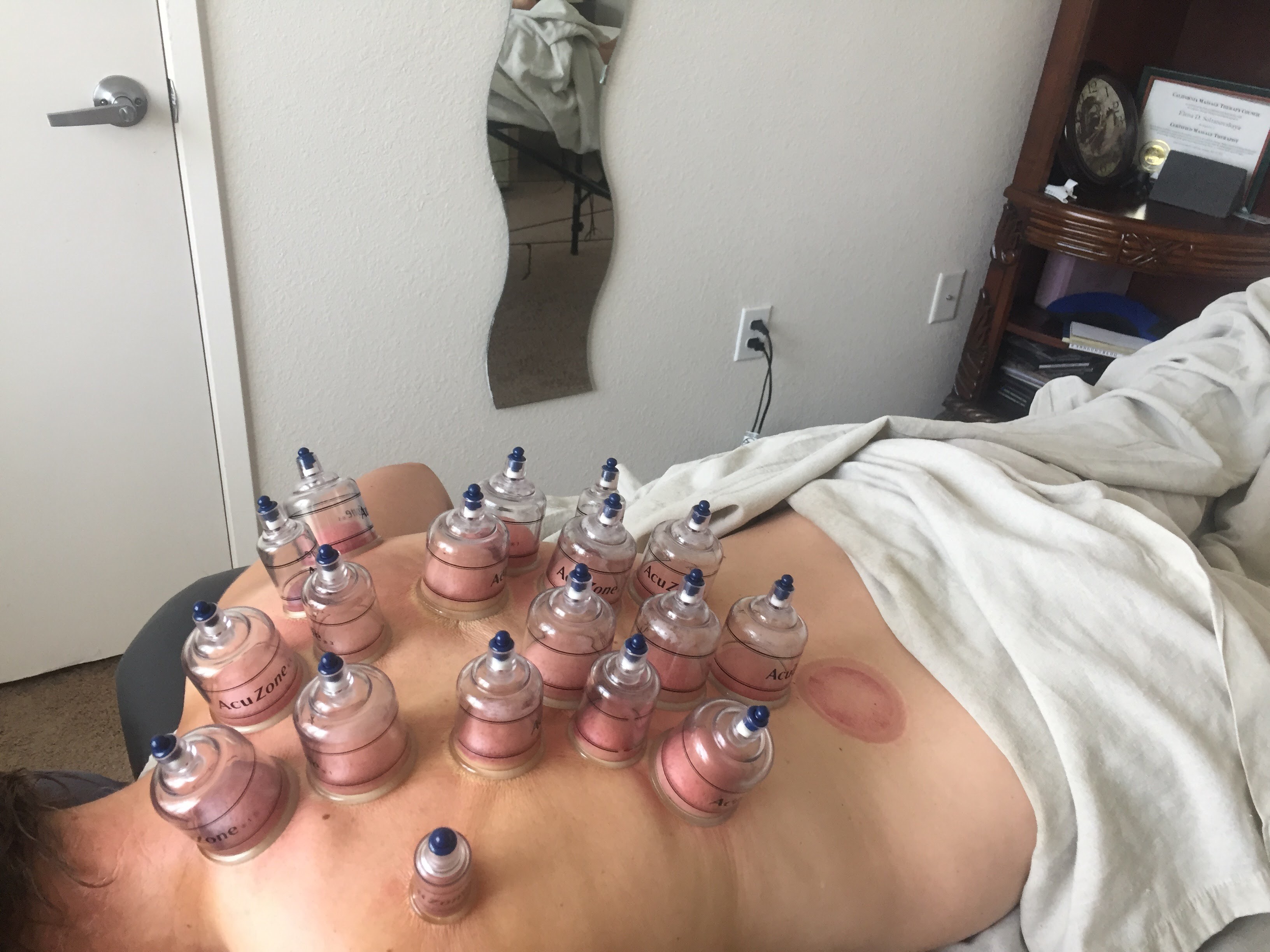 cupping technique